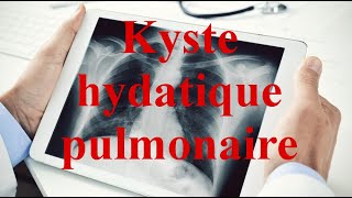 Kyste hydatique pulmonaire [upl. by Ojybbob]