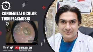 Congenital ocular toxoplasmosis [upl. by Reivaz]