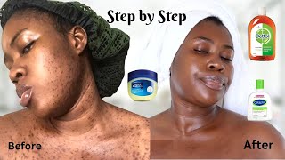 HOW I USED DETTOL AND VASELINE TO CLEAR MY SKIN step by step acne dettol skincare [upl. by Maitland]