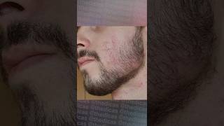 1 ANO E 6 MESES usando Minoxidil minoxidil foligain evolução minoxidil barba barbearia [upl. by Gardol210]