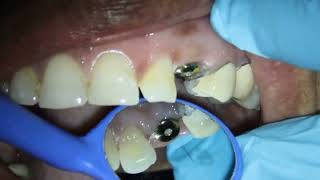 How a Dentist do Implant Crown  Part 1  Implant Crown Impression Making  Measurement Taking [upl. by Oiramat]