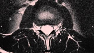 Spinal Myxopapillary Ependymoma [upl. by Olracnaig]