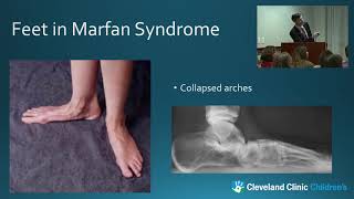 Musculoskeletal Challenges in Marfan Syndrome and the Role of Physical Therapy [upl. by Frodi133]