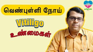 வெண் புள்ளி நோய்  Vitiligo  உண்மைகள்  தமிழ் [upl. by Shargel]