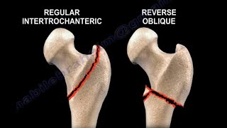 Hip Fractures intertrochanteric hip fractures causes symptoms diagnosis and treatment [upl. by Lalib863]