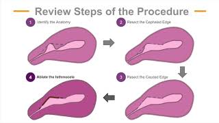 Hysteroscopic Repair of Cesarean Scar Isthmocele [upl. by Ongineb]