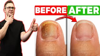 BEST Toenail Fungus Treatment 2024 4 BIG SECRETS [upl. by Ekyt150]