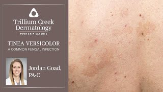 How to spot Tinea Versicolor a common fungal rash [upl. by Lebyram706]