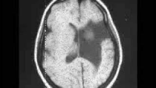 Schizencephaly [upl. by Posehn]