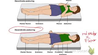 Decerebrate Vs Decorticate Posturing [upl. by Yulma]