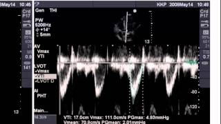 Point of Care Echo Stroke Volume Determination [upl. by Brunhilda]