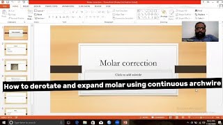 How to do molar derotation and expansion using continuous archwire Toe inToe outbends explained [upl. by Dry]