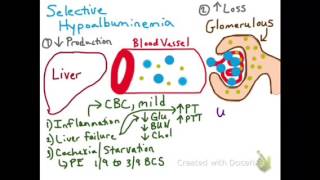 Selective Hypoalbuminemia [upl. by Ahsikam138]