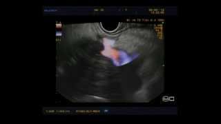 EUS vascular staging of a pancreatic mass [upl. by Yrailih]