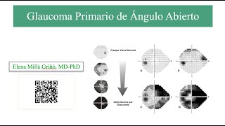 Glaucoma Primario de Ángulo Abierto [upl. by Etneciv]