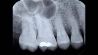 Paralleling Technique and Periapical Radiograph [upl. by Melas885]