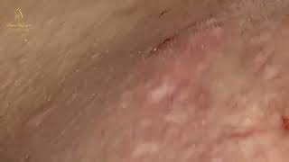 massive blackheads on nose and lips  Clean Giant Blackheads on Nose 2023  spa  hana spa 1091 [upl. by Ronald885]