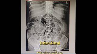 Intestinal obstruction abdomen x ray supine position shortvideo [upl. by Vassily]