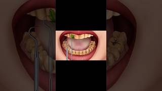 Teeth cleaning teeth dentalcare clinic feedshorts feed tiktok reels instagram gaming gamer [upl. by Yehsa]