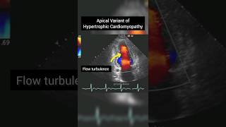 Apical Variant of Hypertrophic Cardiomyopathy on Echocardiography anatomy heart [upl. by Acysej]