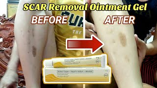 PANTANGGAL NG OLD SCARPEKLAT  Contractubex Ointment Gel REVIEW Explained [upl. by Aylmer]