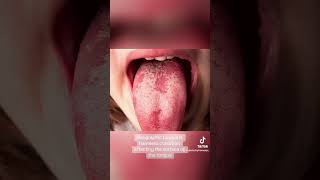 Geographic tongue dentist dentallove dentistrylove dentalworld [upl. by Namra]