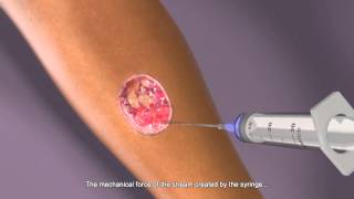 SilverStream for Chronic Wound Management  How does it work [upl. by Erhart448]