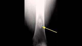 Enchondroma Distal Femur [upl. by Claman]