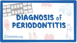 Diagnosis of Periodontitis [upl. by Aratak]