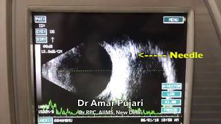 Continuous B scan ultrasound guided post traumatic subperiosteal orbital hematoma drainage [upl. by Suitangi854]