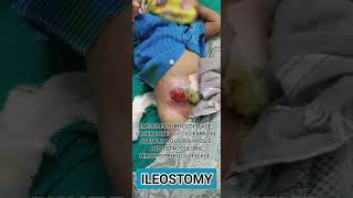 Ileostomy  indication where it is donesurgery [upl. by Nnahaid]