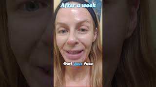 Wrinkles Be Gone with AtHome Chemical Peels nobotox antiagingskincare chemicalpeels [upl. by Ileek16]