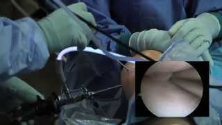 Arthroscopic Knee Surgery Meniscus Tear [upl. by Yelwah]