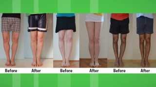 Bow Legs Correction Exercises  How to fix Bow Legs  Bow Legs Correction without surgery [upl. by Saberio169]