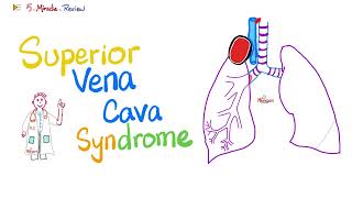 Superior Vena Cava SVC Syndrome  Pancoast Tumor  Pathology  Oncology  5MinuteReview [upl. by Nahtaj]