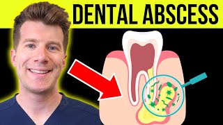 Doctor explains DENTAL ABSCESS tooth abscess  Causes symptoms amp treatment [upl. by Oman]