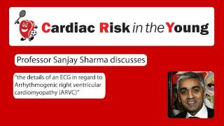 ECG 7 Arrhythmogenic right ventricular cardiomyopathy ARVC [upl. by Anahoj790]