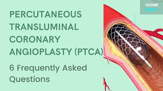 Percutaneous Transluminal Coronary Angioplasty 6 Frequently Asked Questions [upl. by Mitman]