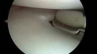 Arthroscopic Partial Meniscectomy [upl. by Bevvy]