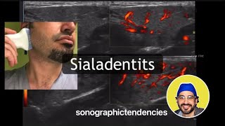 Sialadenitis [upl. by Dennison]