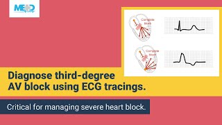 Examining a thirddegree AV block [upl. by Herrod]