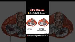 Heart sounds🫀 Heartsounds doctor heart sounds medicalstudy neet medicalstudent chestpain 🫀 [upl. by Aniri]