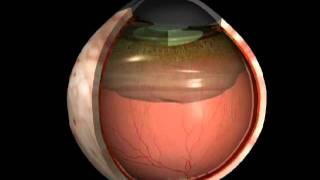 PosteriorVitreousDetachment  evrs [upl. by Ayiotal]