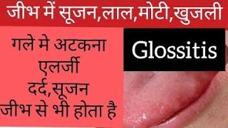 Glossitis 👅 ka Ayurvedic treatment 🎋Kaise phchane🤔 Glossitis ke lakshanhealth ayurveda fact [upl. by Nytsirhc996]