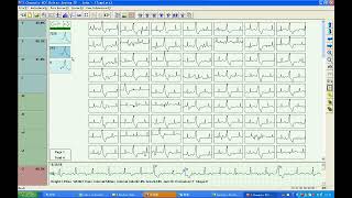 TLC9803 3 leads 3 Channels ECG Holter Operation English [upl. by Lynne87]