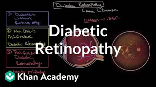 Diabetic retinopathy  Endocrine system diseases  NCLEXRN  Khan Academy [upl. by Ttereve]