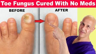 Toe Nail Fungus Cured With No Meds Dr Mandell [upl. by Oehsen274]