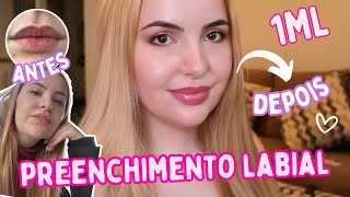 PREENCHIMENTO LABIAL COM 1 ML  ANTES E DEPOIS [upl. by Dammahum829]