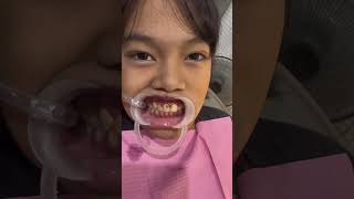 Libreng pasta ng ngipin Free tooth restoration [upl. by Maidy]