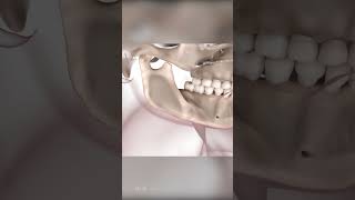 Corrective Jaw Surgery Orthognathic Surgery [upl. by Aicilyhp]